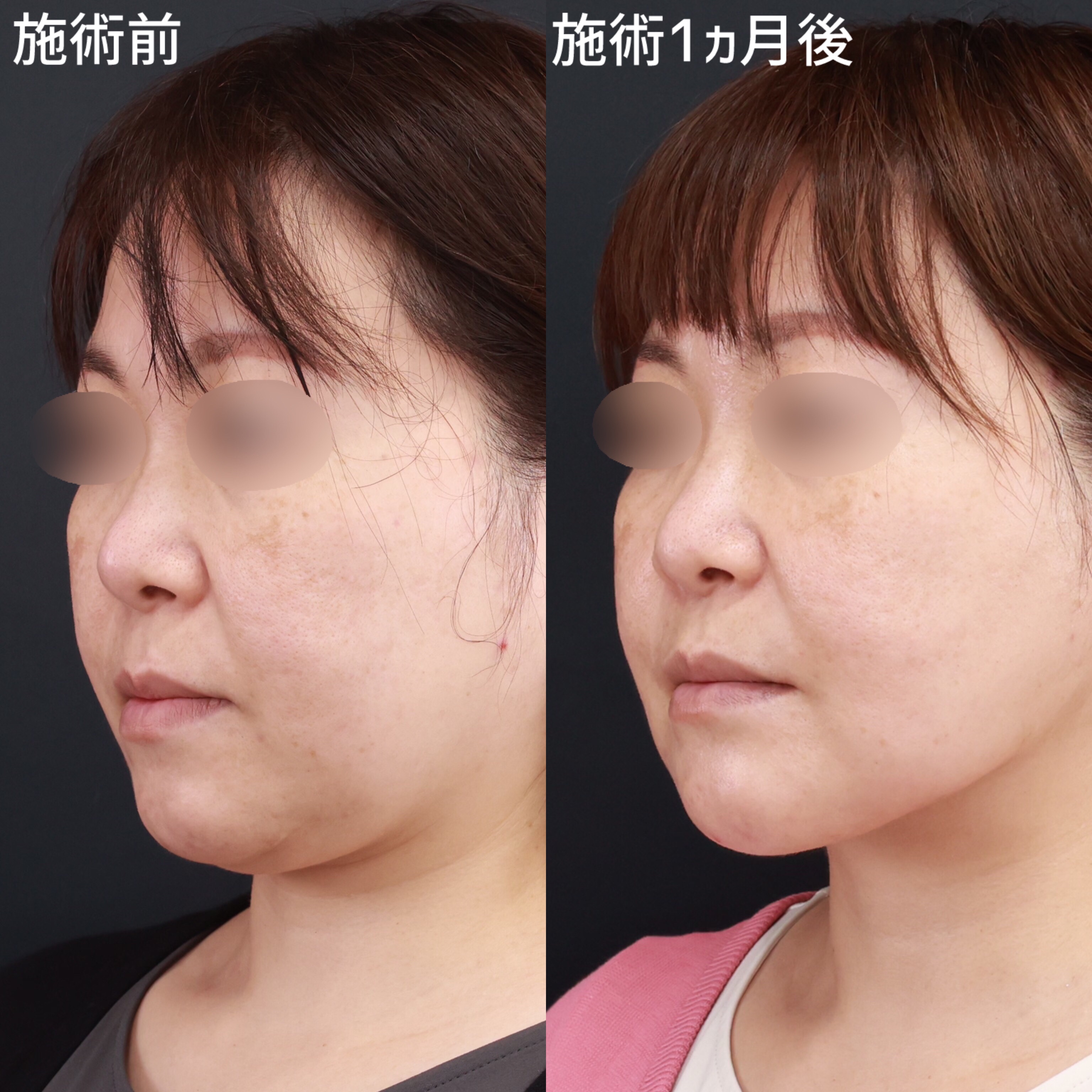 プチ整形 手術 大阪の症例写真・画像・ビフォーアフター｜美容整形