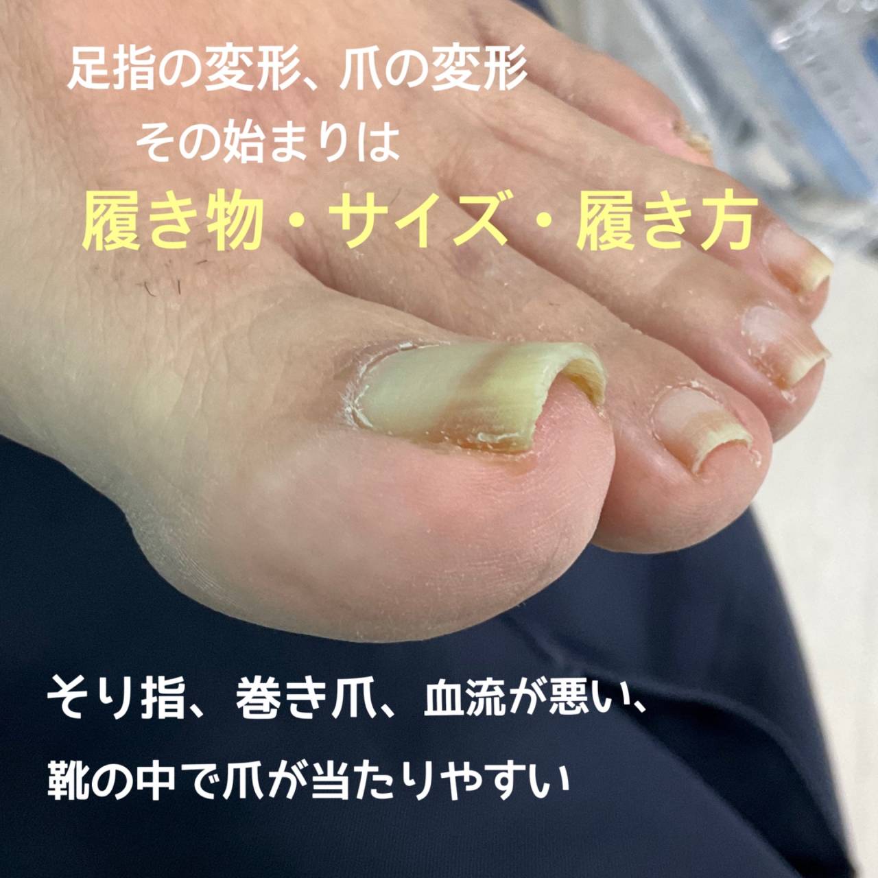 反り指の巻き爪補正 BSスパンゲ 看護師による爪ケア専門店 | サロン