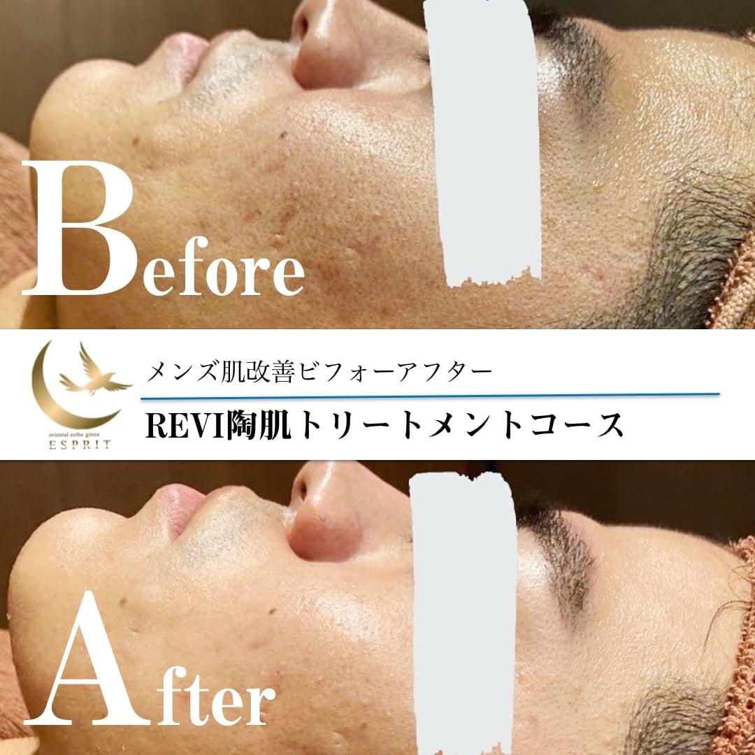 REVIハーブピーリングトリートメント【オム】 ｜東京銀座、新宿の