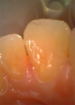 虫歯治療【勝どきザ・タワー歯科】勝どきの歯医者・歯科｜土曜も診療