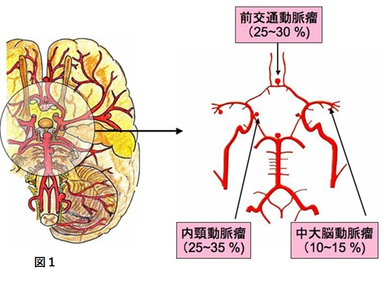脳動脈瘤| 慶應義塾大学病院脳神経外科教室