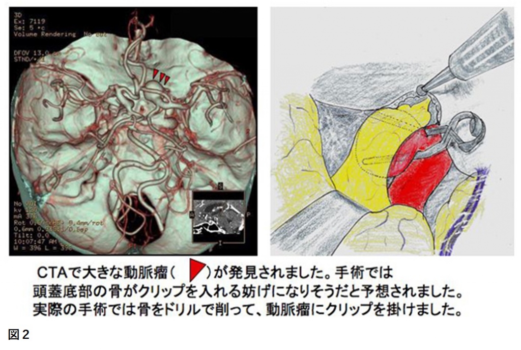 脳動脈瘤| 慶應義塾大学病院脳神経外科教室