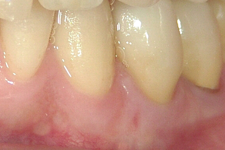 精密根管治療で抜歯せずに歯を保存した審美修復治療から14年10か月