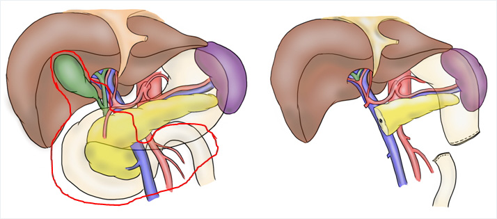 手術術式（膵臓手術・肝臓手術）｜患者の方へ｜東北大学病院 総合外科