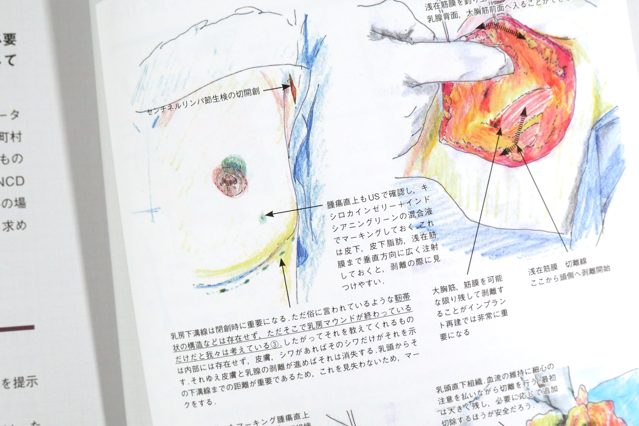 手術記録の描き方・活かし方 デジタルイラストで描くオペレコ入門