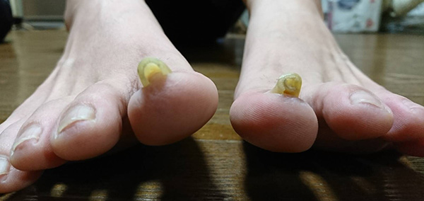 大東市からお越しのお客様【ぐるぐるの巻き爪】 | 巻き爪矯正するなら