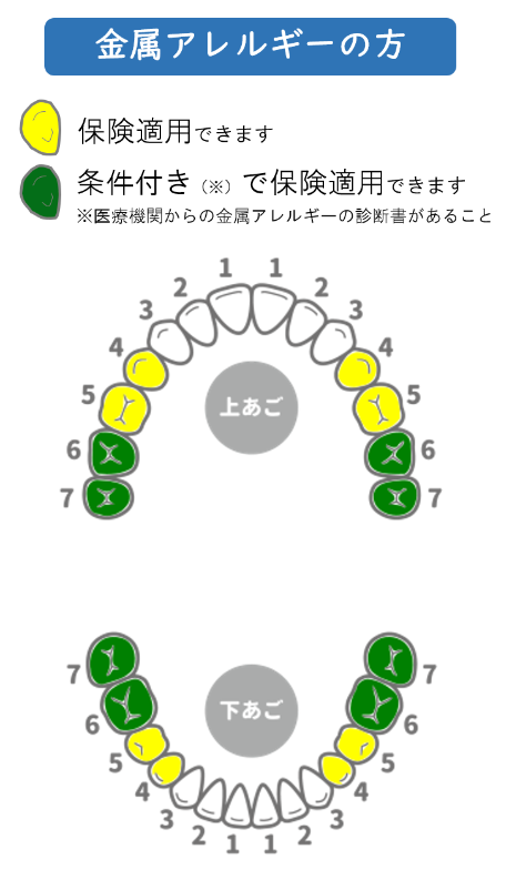 NEWS】2023月12月1日から大臼歯(奥歯)の白い歯「PEEK」が新保険適応
