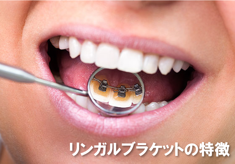 代表的な矯正方法②リンガルブラケットの特徴 | 五反田の歯医者