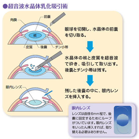 日帰り白内障手術 | 静岡県伊東市にある長谷川眼科｜静岡県伊東市に