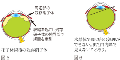 さまざまな目の病気-硝子体手術について | 神戸市灘区の中川眼科医院