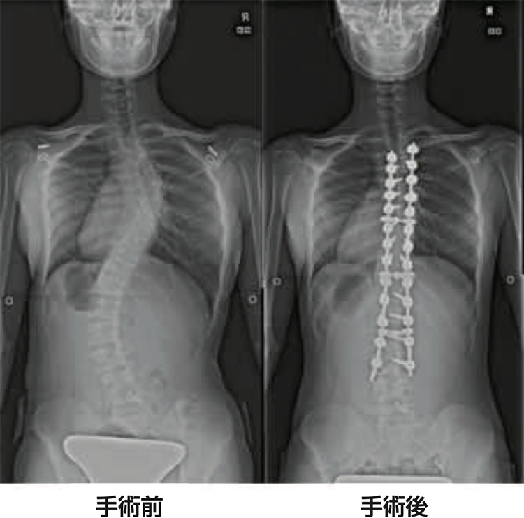 最新医療を駆使した小児脊柱変形手術 | 病気と治療の検索サイト