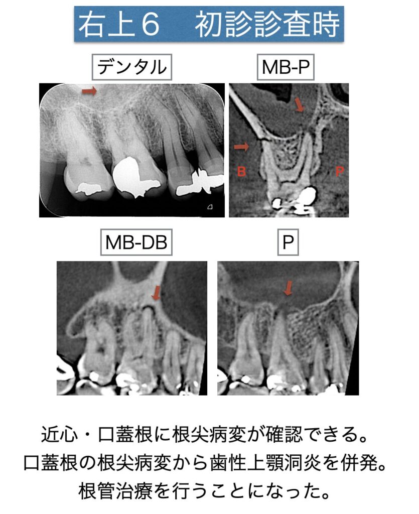 右側が歯性上顎洞炎になっている。根管治療により治癒した症例。 | 歯