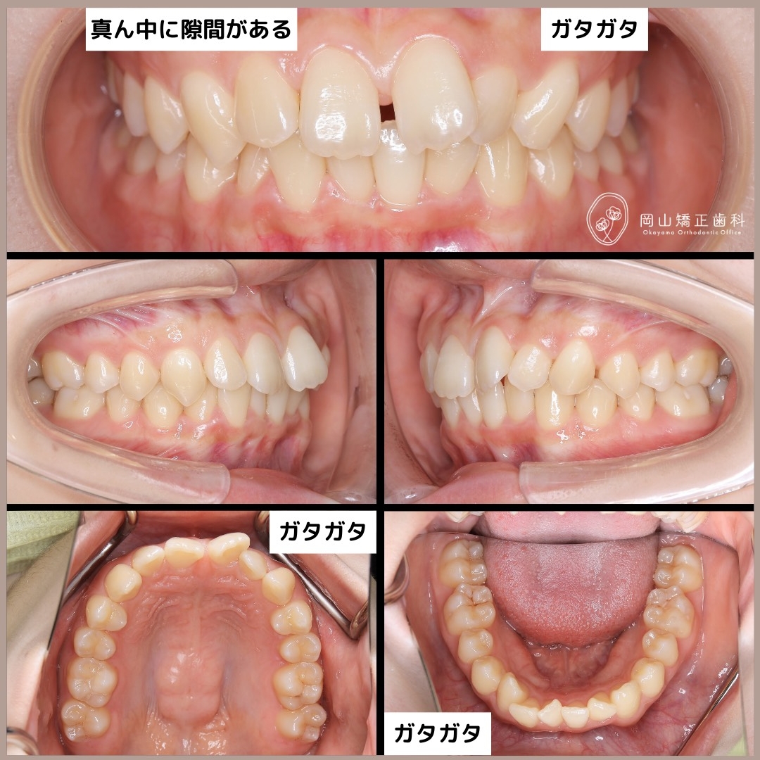 アライナー矯正（マウスピース型矯正装置） | 岡山矯正歯科