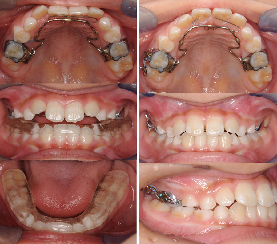 成長期の反対咬合治療例 | おかざき矯正歯科クリニック 茨城県水戸市の