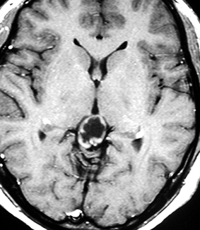 松果体実質腫瘍の症例 pineal parenchymal tumor | 脳外科医 澤村豊の