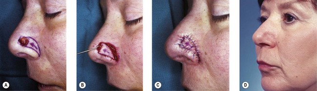Local flaps for facial coverage | Plastic Surgery Key